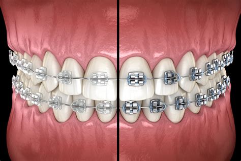 ceramic brackets with metal wire|are ceramic braces more expensive.